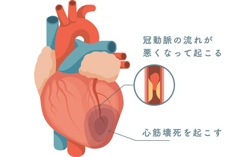 虚血性心疾患のイメージ写真1